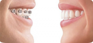 Los frenillos cambiaron la sonrisa de éstos famosos