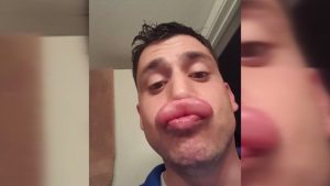 Este joven fue picado por una avispa en el labio y se burló de las mujeres que se ponen bótox