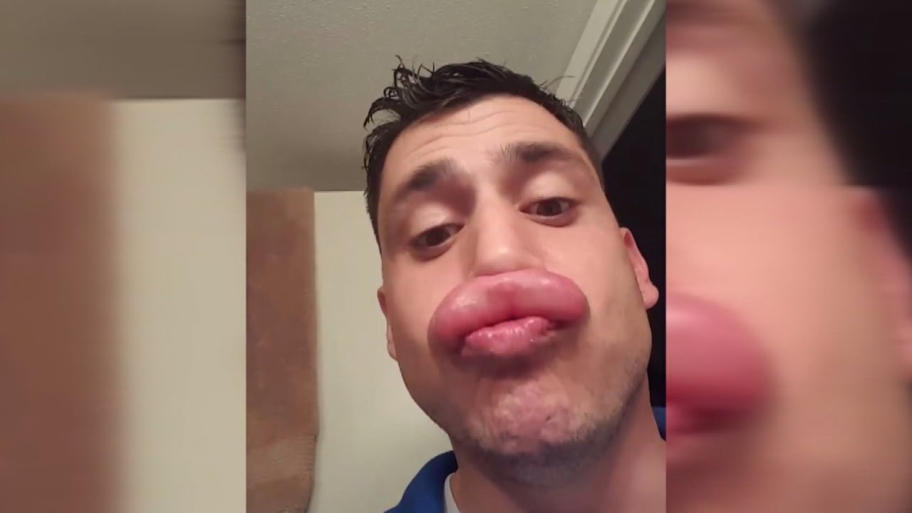 Este joven fue picado por una avispa en el labio y se burló de las mujeres que se ponen bótox