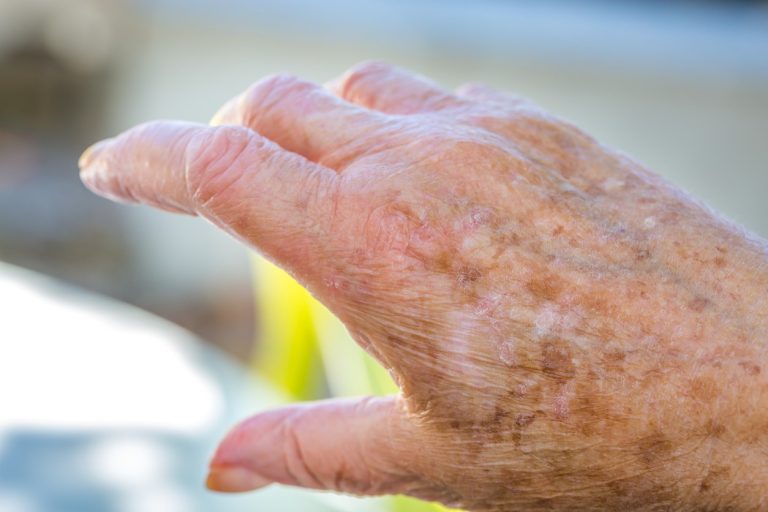 Conoce qué remedios caseros puedes utilizar para eliminar las manchas de la edad