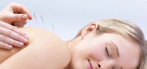 Punción seca: Conoce esta efectiva técnica para relajar la musculatura
