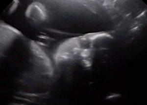 ¡Impresionante! Guagua de 28 semanas saluda y mira a sus padres en la ecografía