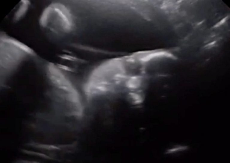 ¡Impresionante! Guagua de 28 semanas saluda y mira a sus padres en la ecografía