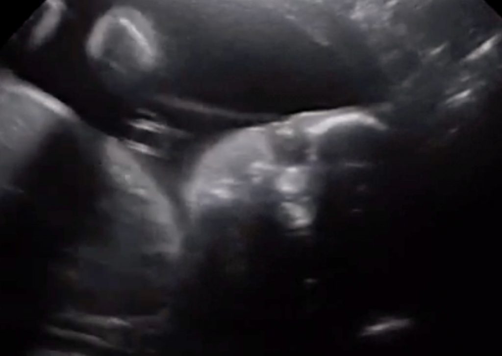 ¡Impresionante! Guagua de 28 semanas saluda y mira a sus padres en la ecografía