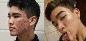 Joven encontró la fórmula perfecta para quitarse el acné