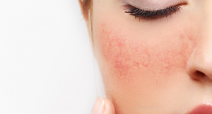 ¿Picazón en tu piel? Presta atención, pues puede ser el detergente que usas