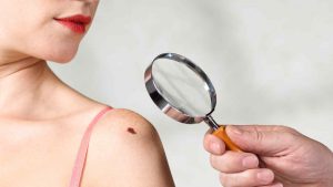 Científicos crean test para detectar el cáncer de piel antes de que se expanda