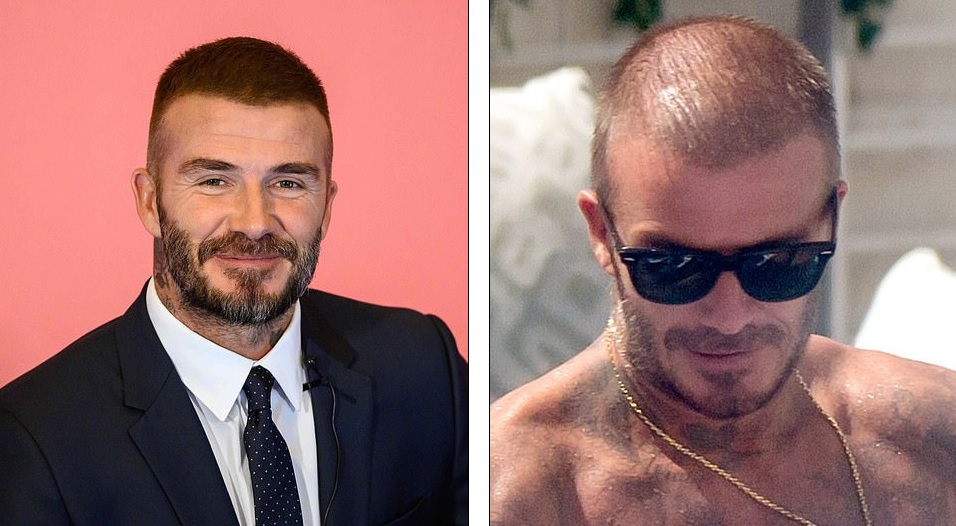 La polémica foto de David Beckham ¿Tiene implantes de pelo? — FMDOS