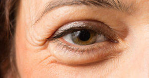 ¿Cómo se pueden atenuar o eliminar las bolsas bajo los ojos?