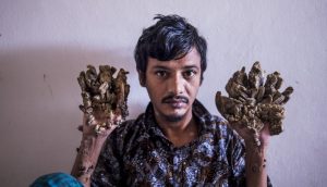 Hombre conocido como el "Hombre árbol" pidió que le amputaran sus manos debido al dolor