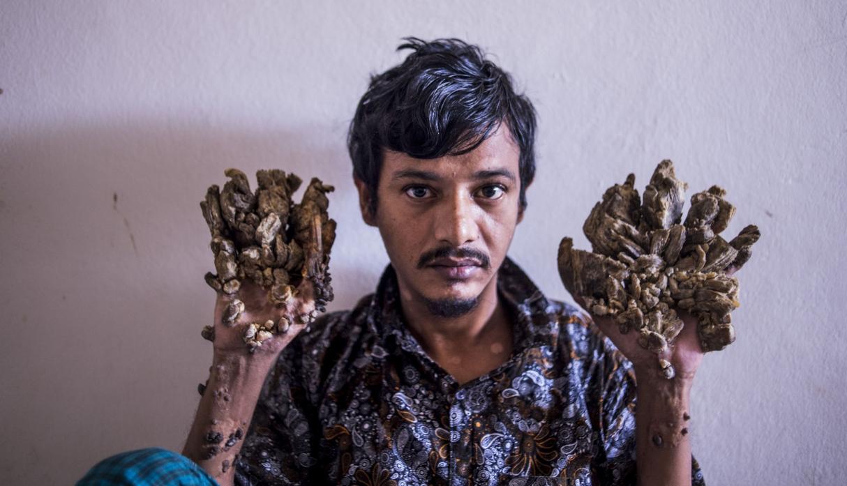 Hombre conocido como el "Hombre árbol" pidió que le amputaran sus manos debido al dolor