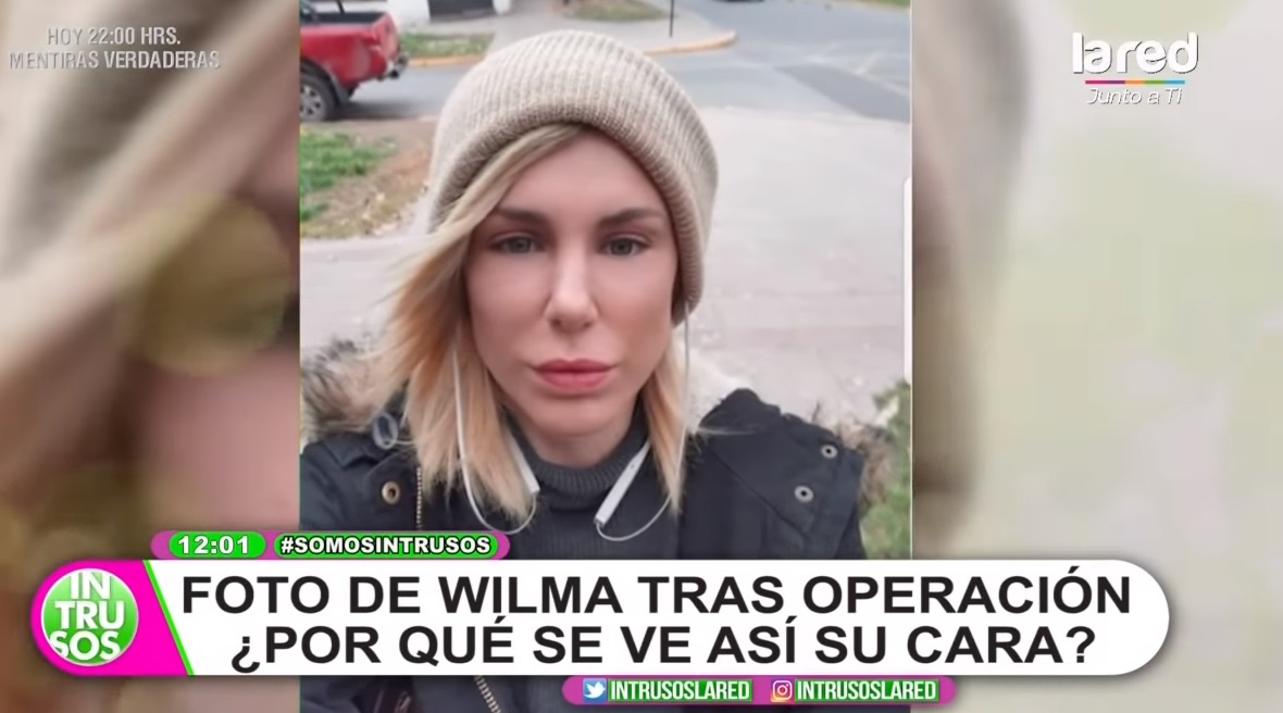 Cirujano plástico se refirió a rinoplastía de wilma 