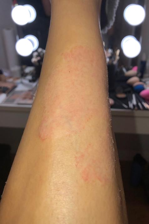 kim kardashian psoriasis