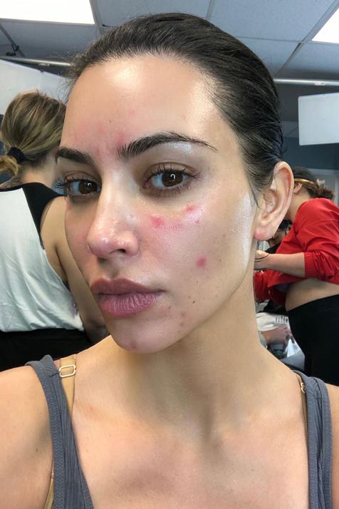 kim kardashian psoriasis