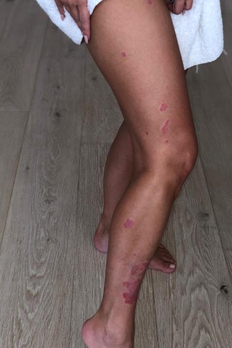 kim kardashian psoriasis