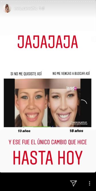 carvalho compartió el antes y despues de su dentadura