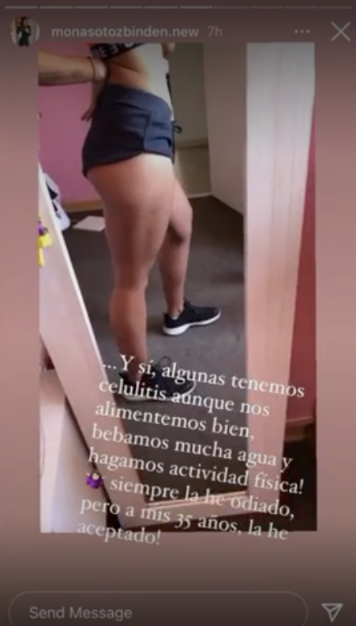 monica soto celulitis