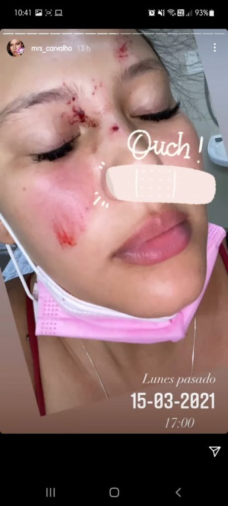 Michelle Carvalho sufre accidente