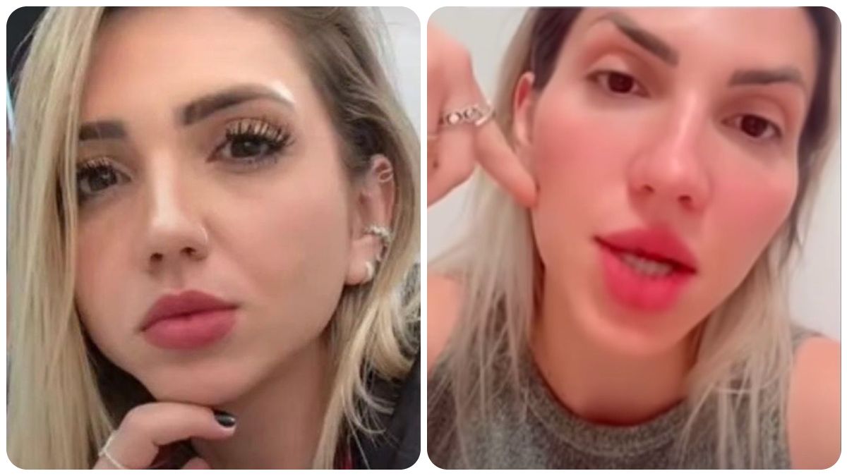 Influencer quedó irreconocible después de hacerse bichectomía