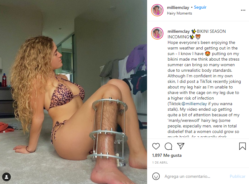 Mujer sufrió grave accidente en su pierna y ¡no puede depilarse! 