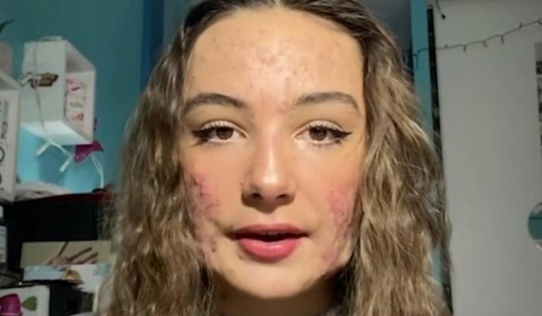 Joven con acné severo cuenta su día a día en TikTok