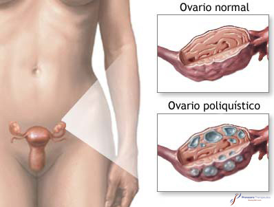 Ovario Poliquistico