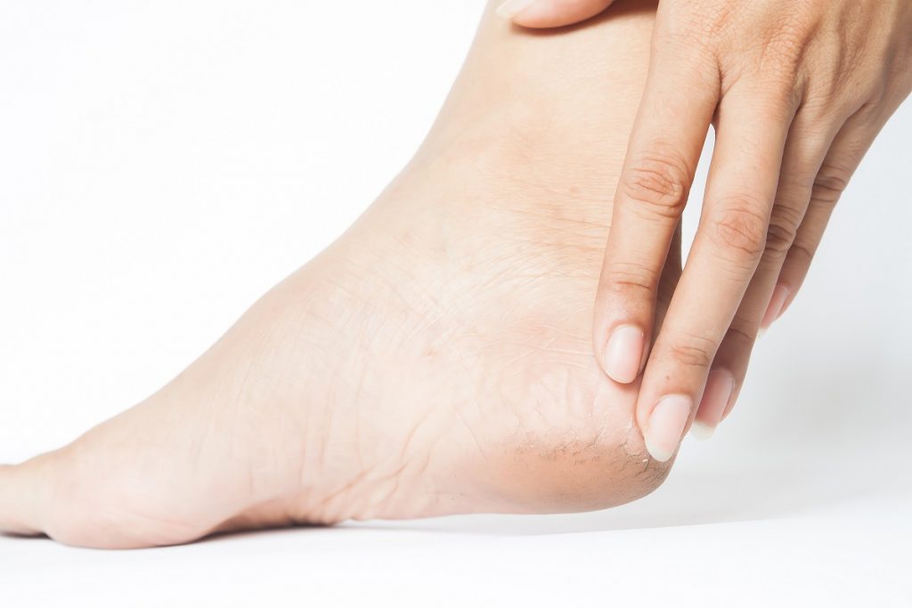 Woman Cracked Heels With White Background, Foot Healthy Concept
