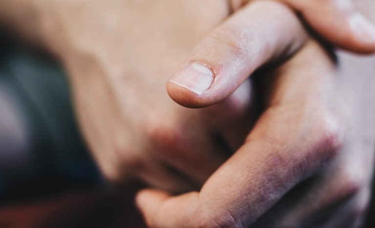 ¿Las uñas quedan con secuelas post Covid-19? Estos dicen los doctores
