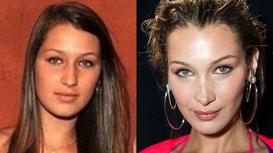 Antes Y Despues Bella Hadid