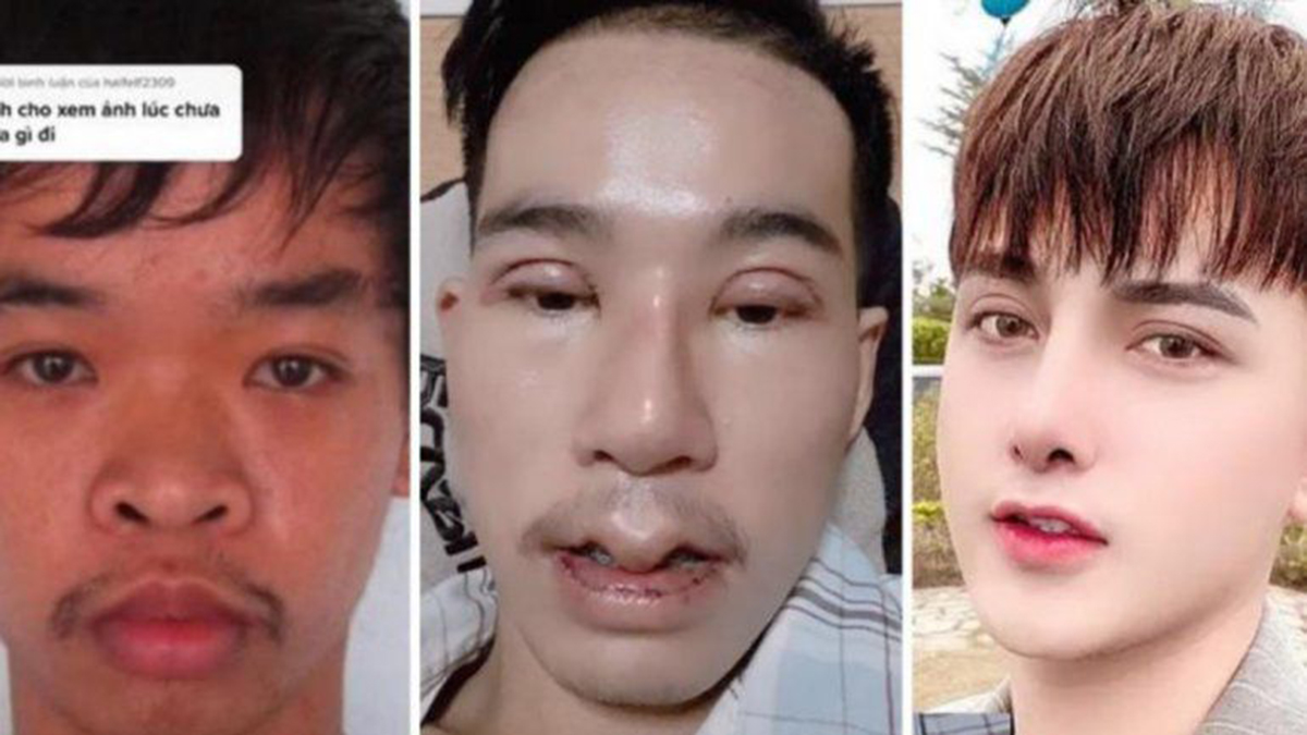 Viral en TikTok: se operó la cara porque lo rechazaban en entrevistas laborales