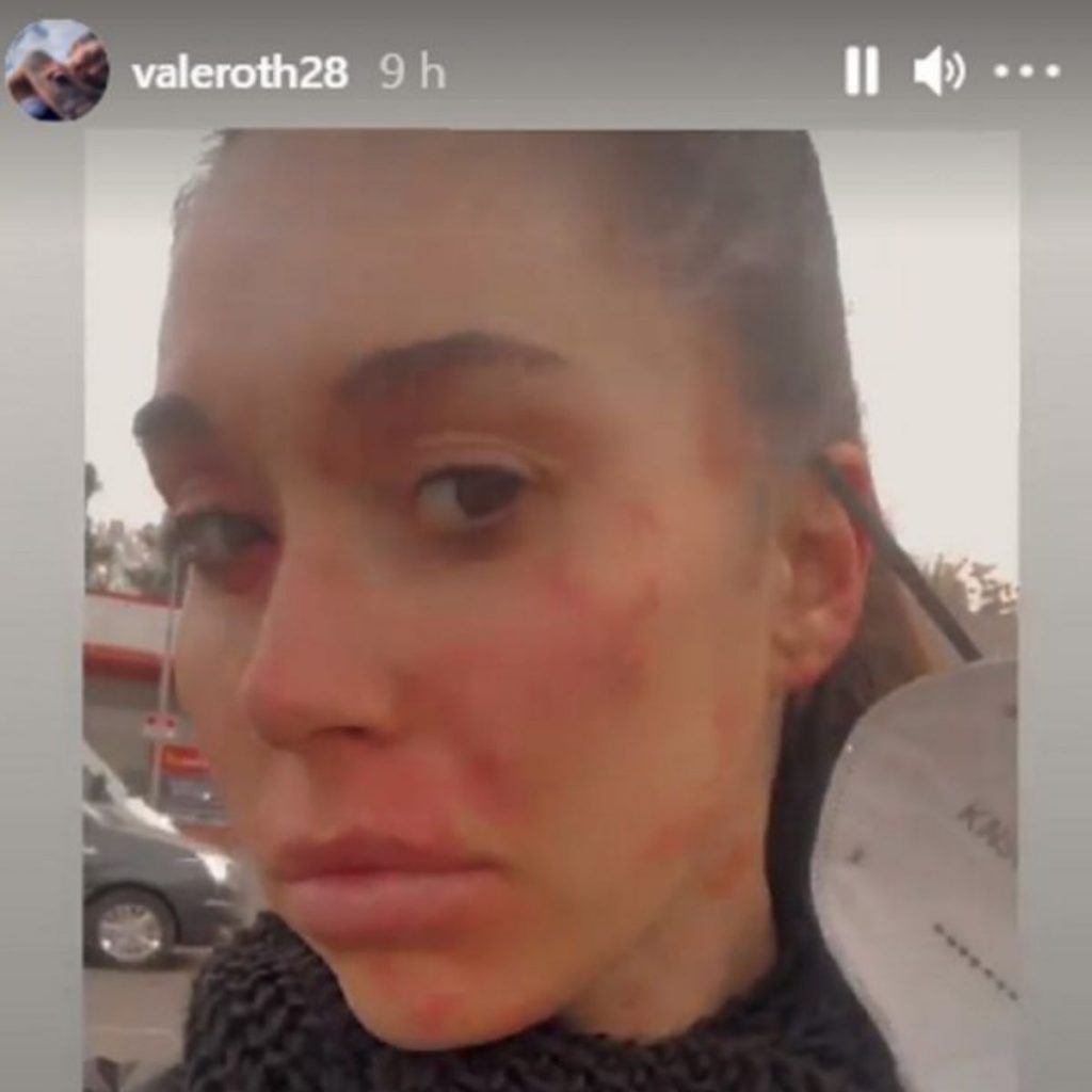 Valentina Roth Reacción Piel