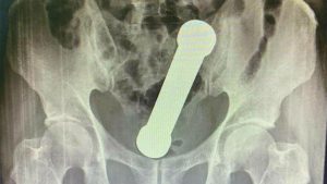 Un hombre terminó con una pesa de dos kilos en el recto