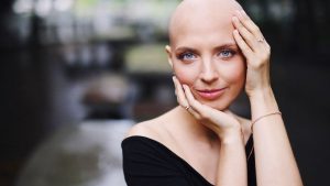 La Alopecia