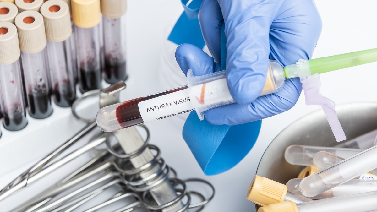 Caso sospechoso de ántrax es detectado en SAPU de Lampa