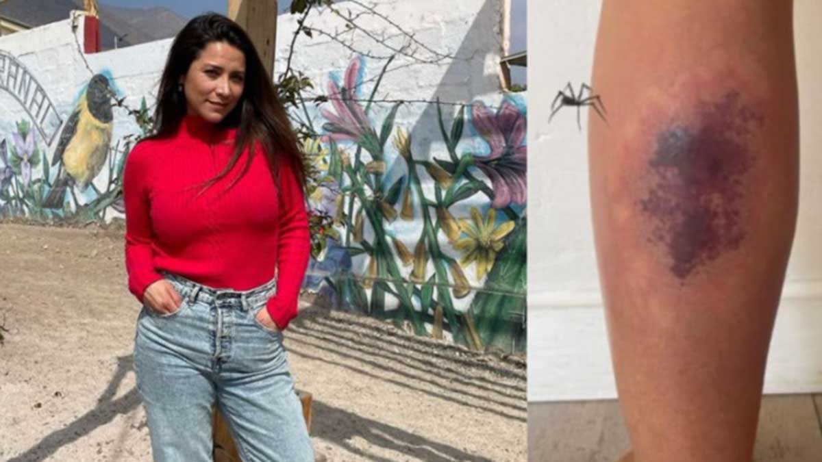 "El dolor es horrible": Loreto Aravena actualizó su estado de salud tras la picadura de araña