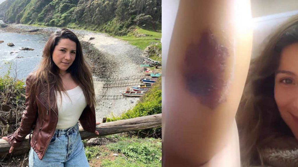 Loreto Aravena picadura de araña