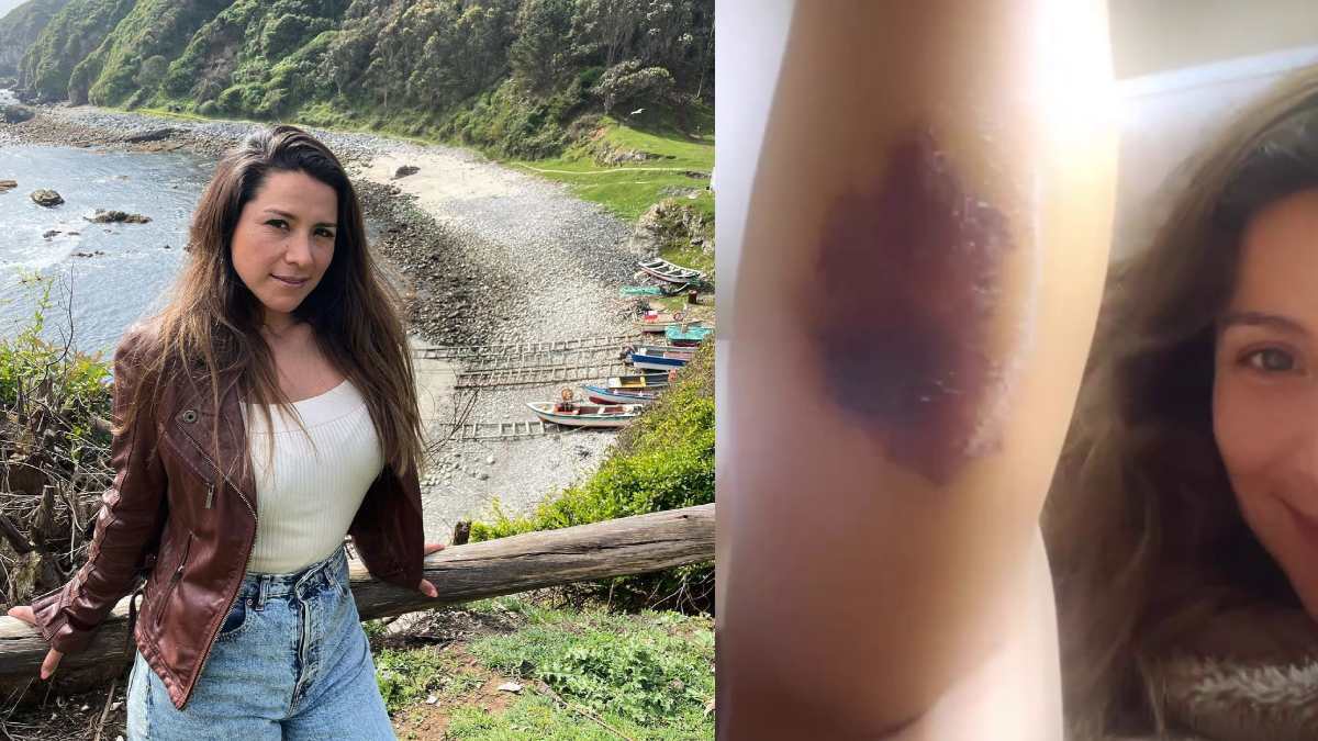 Loreto Aravena actualiza su estado de salud tras grave mordedura de araña