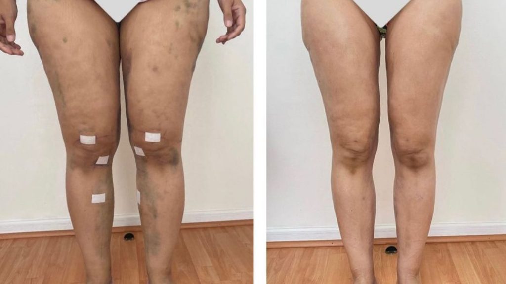 Lipedema