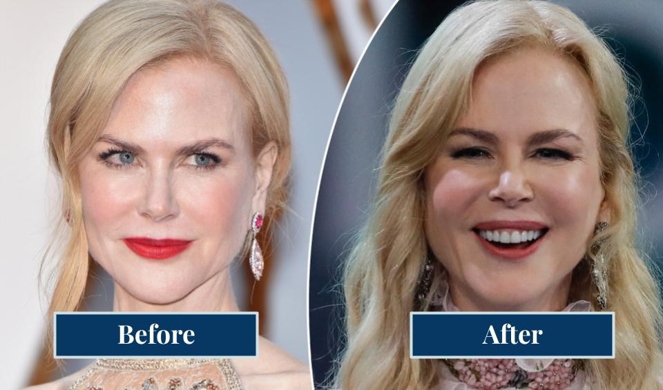 Nicole Kidman Before And After Pillow Face