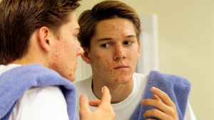 ¿Problemas de acné?: Estas son las plantas medicinales que te pueden ayudar a combatirlo