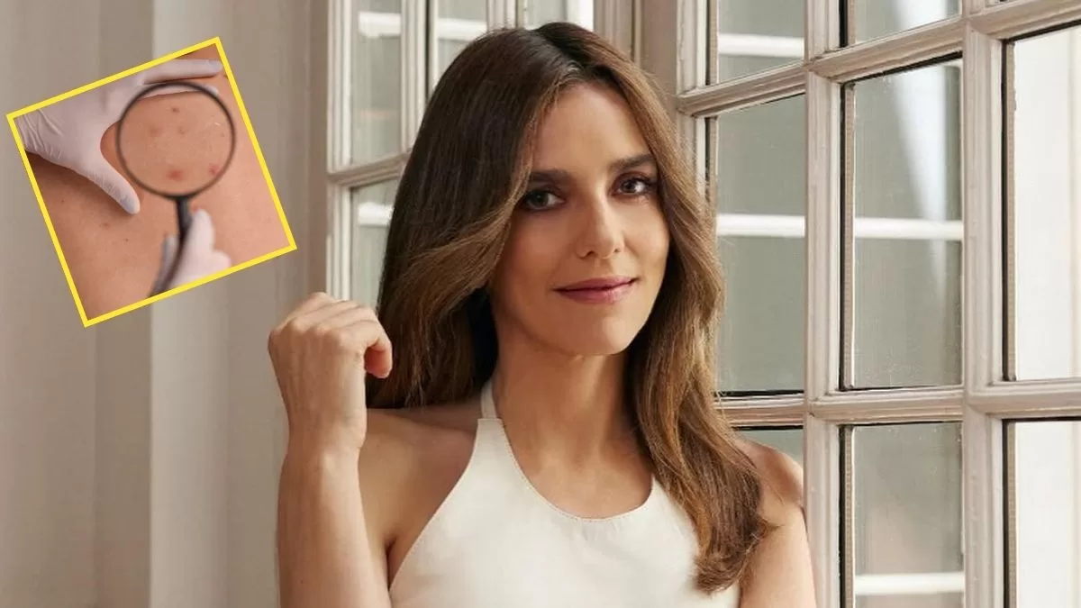 ¿Qué es un melanoma? El agresivo tipo de cáncer que afectó a María Luisa Godoy y Javiera Suárez