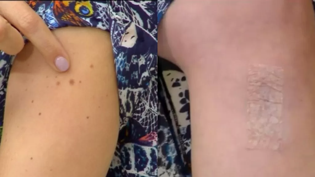 María Luisa Godoy Melanoma