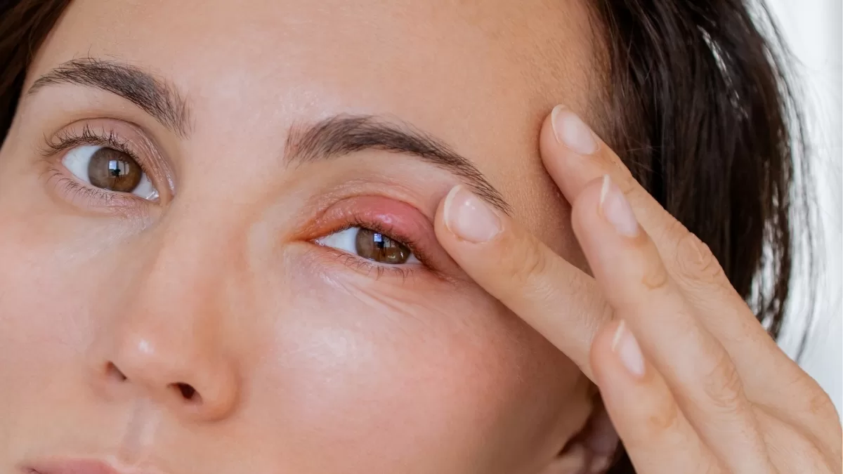 ¿Qué es un chalazión?: El problema médico que llevó a Pamela Díaz a someterse a cirugía