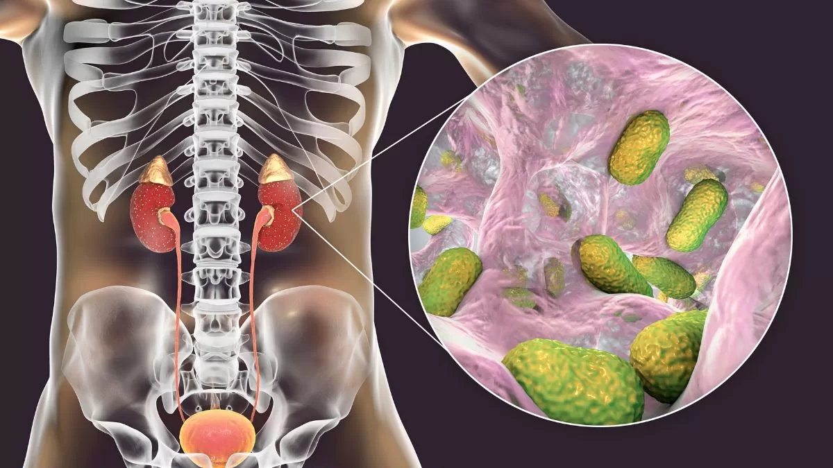 Pielonefritis Qué Es (3)