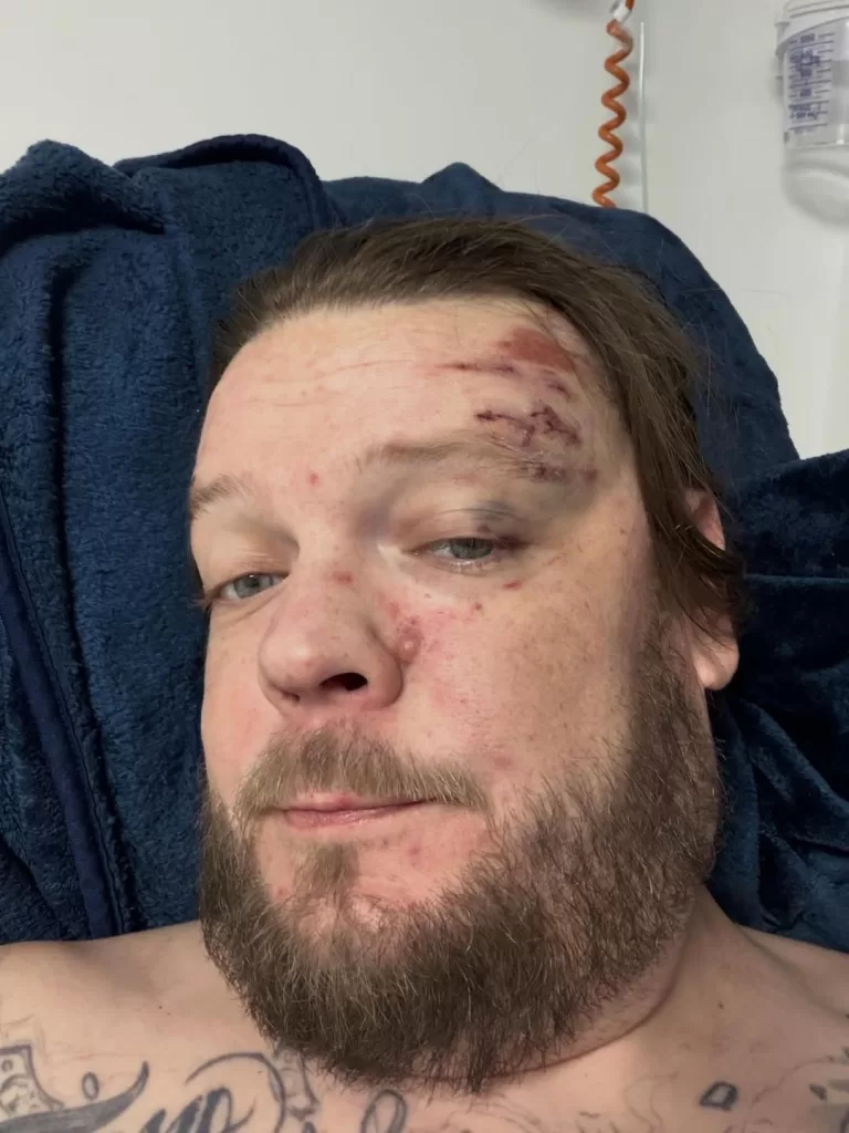 Grave Accidente Rostro De Tv Corey Harrison