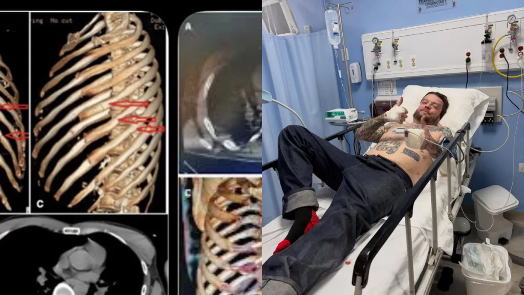 Grave Accidente Rostro De Tv Corey Harrison