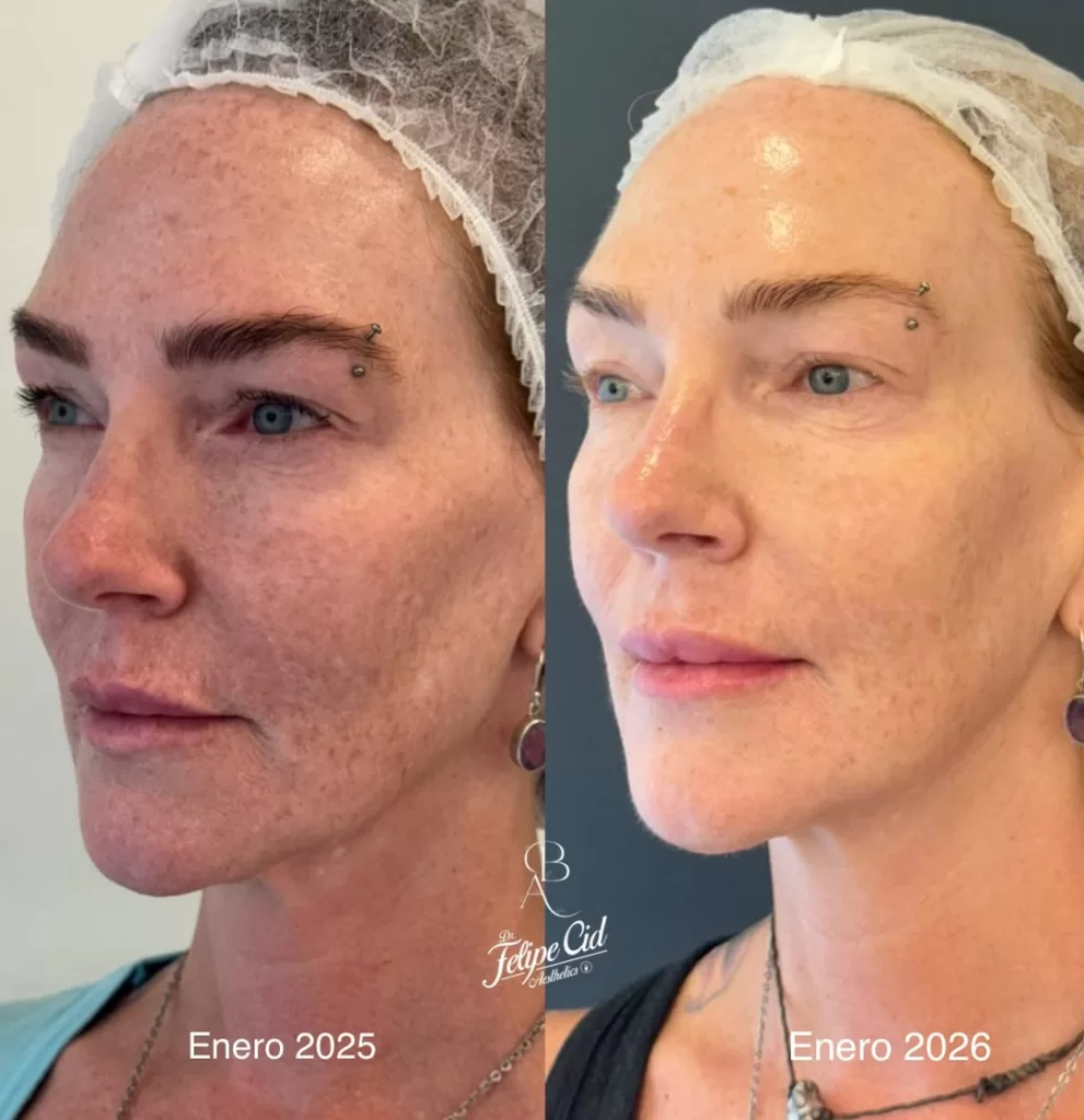 Cata Pulido Antes Y Después Cirugia