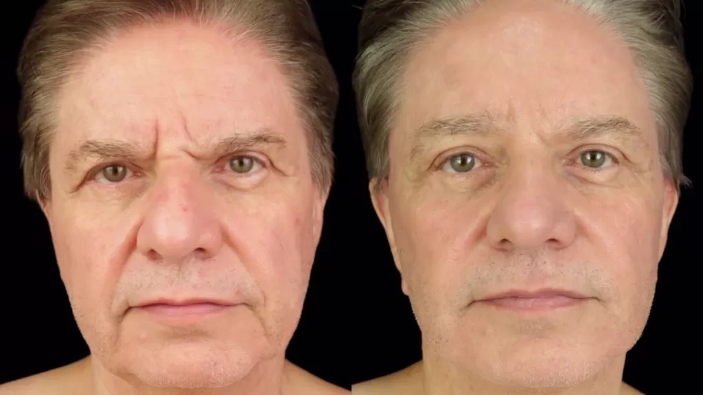 Carlos Caorsi Antes Y Despues